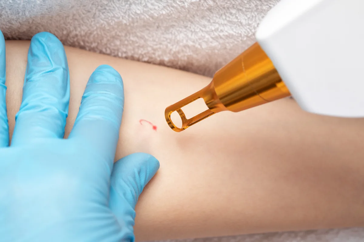 Remoción de Tatuajes